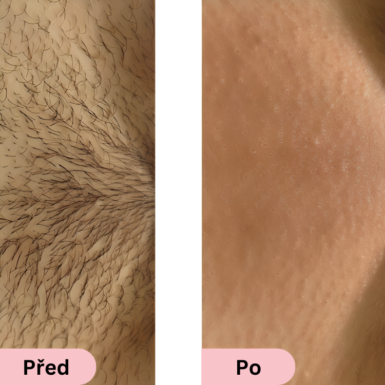 Glowie™ IPL Fotoepilátor – Přístroj na odstraňování chloupků