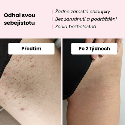 Glowie™ IPL Epilátor – Zařízení pro odstranění chloupků
